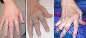 manos con osteoartrosis