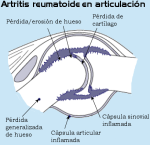 Artritis en las articulaciones
